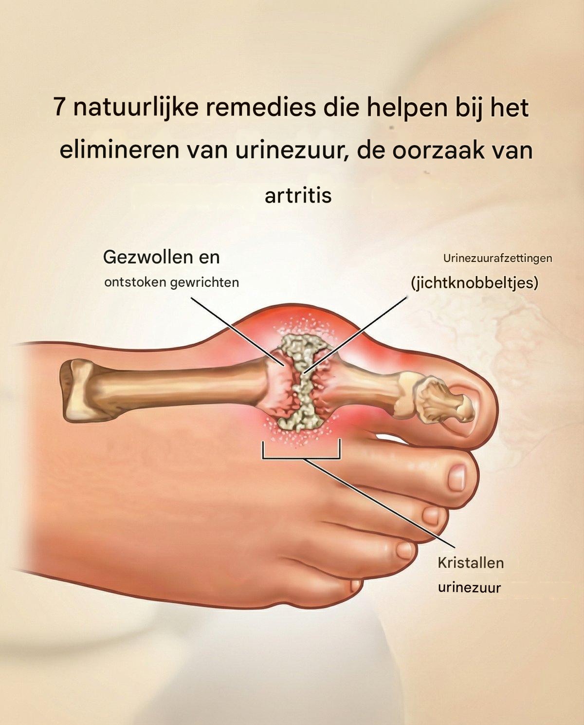 7 natuurlijke remedies die helpen bij het elimineren van urinezuur, de oorzaak van artritis